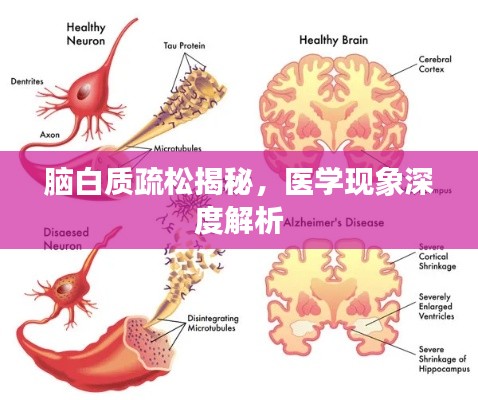 脑白质疏松揭秘,医学现象深度解析